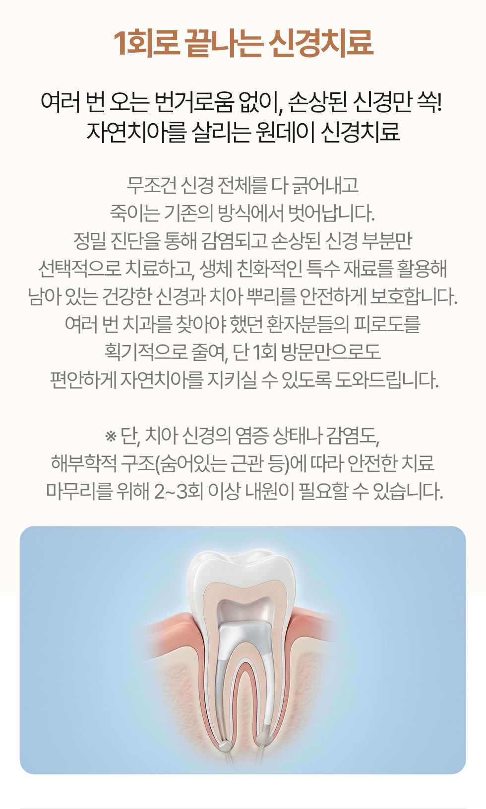 1회로 끝나는 신경치료 - 원데이 신경치료