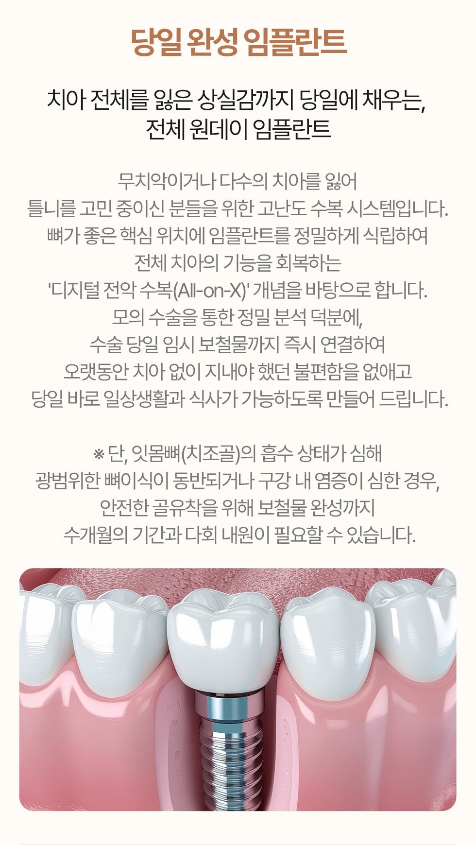 당일 완성 임플란트 - 전체 원데이 임플란트