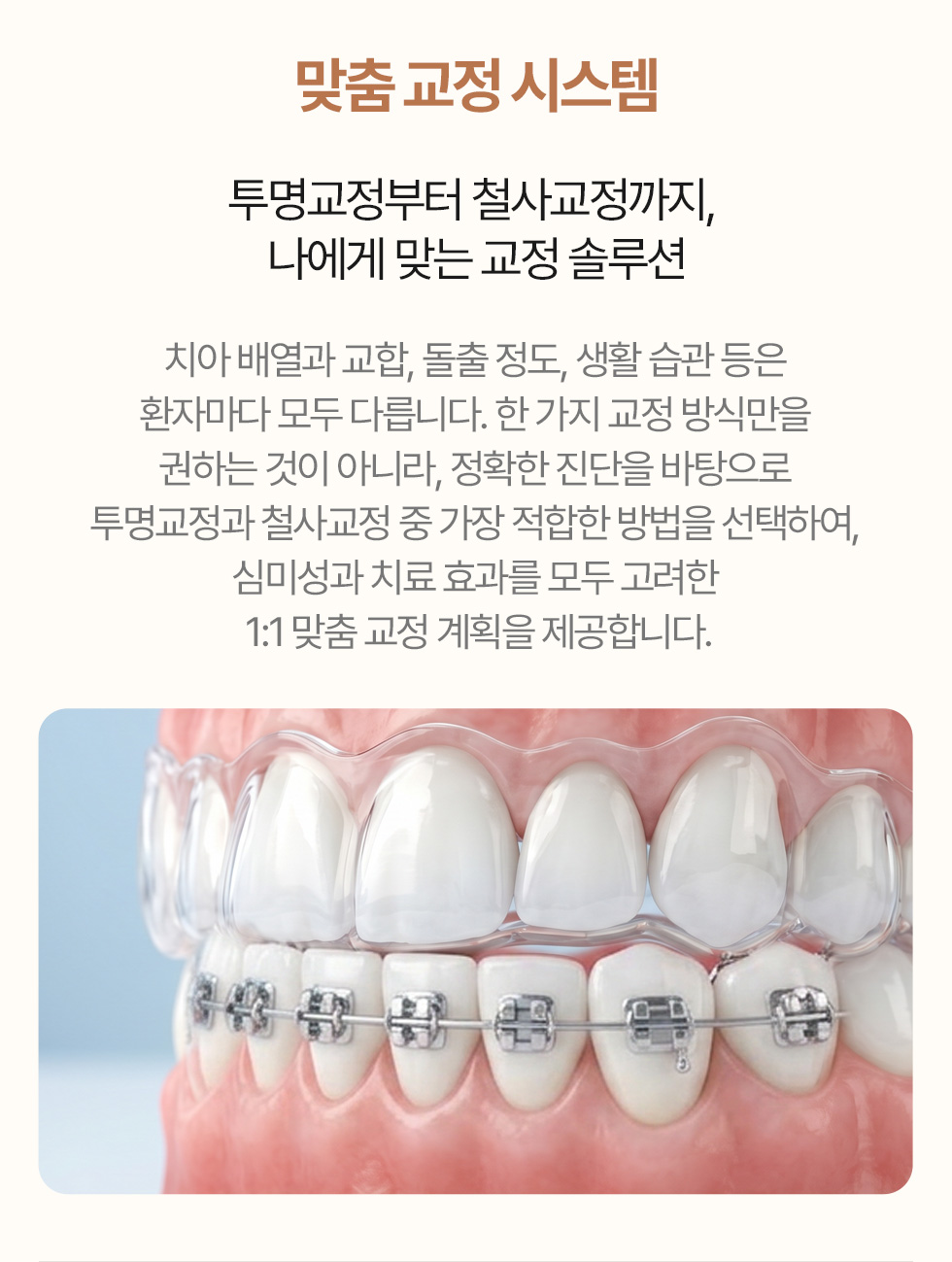 맞춤 교정 시스템 - 투명교정부터 철사교정까지