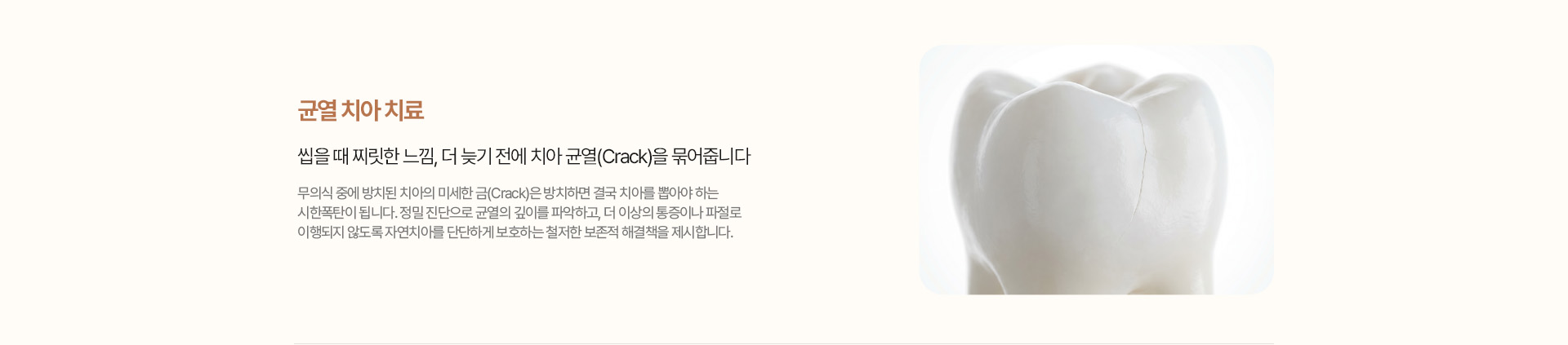 균열 치아 치료 - 자연치아 보존 솔루션