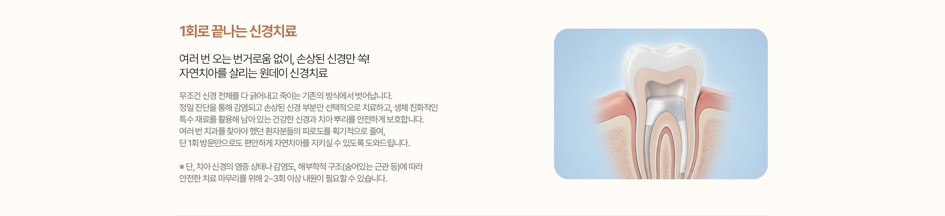 1회로 끝나는 신경치료 - 원데이 신경치료