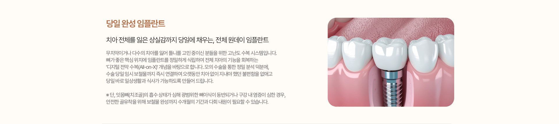 당일 완성 임플란트 - 전체 원데이 임플란트