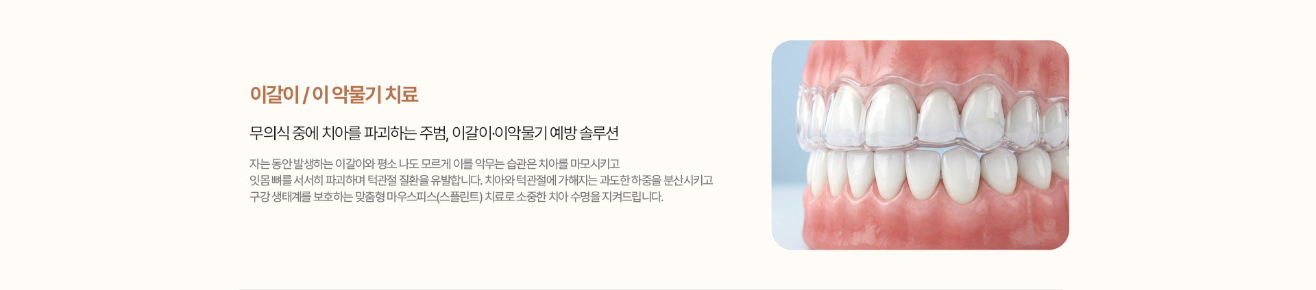 이갈이와 이 악물기 치료 - 맞춤형 마우스피스
