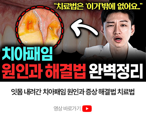 치아패임 원인과 치료 방법