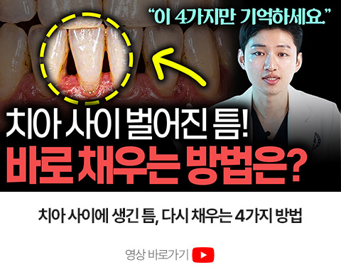 치아 사이 벌어진 틈을 채우는 방법