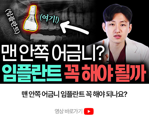맨 안쪽 어금니 임플란트 필요성